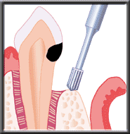 bone trimmed to access decay and gum to reattach