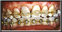 tissue surgically trimmed to normal contour