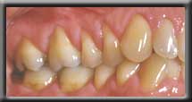 root coverage upper premolar left side image one