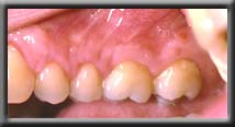 root coverage upper premolar right side image two