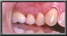 root coverage upper premolar left side image two