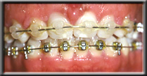 overgrown gum tissue during orthodontics