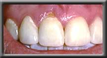 front tooth with unsightly root exposed