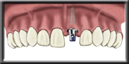 implant diagram 3