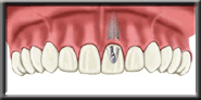 implant diagram 4