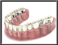 implant diagram 6