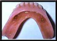lower denture