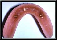 underside of denture showing clips
