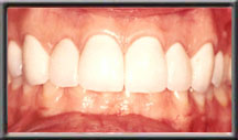 post tissue sculpting and veneers