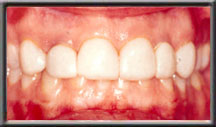 short teeth with irregular gum margin